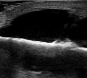 Chấn thương cẳng chân