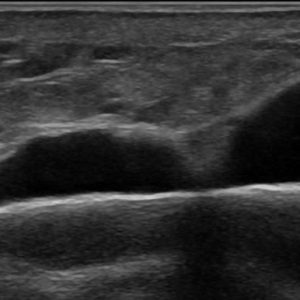 Chấn thương cẳng chân