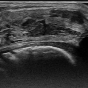 Dị dạng mạch máu