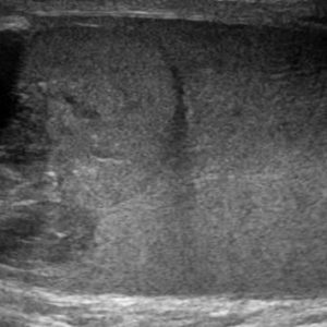 U tinh hoàn
