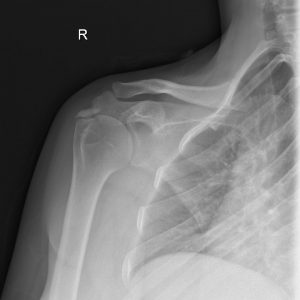 Viêm gân vôi hóa