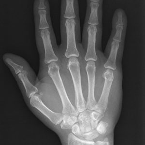 Chấn thương bàn tay