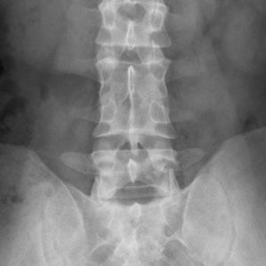 Dính thân đốt sống