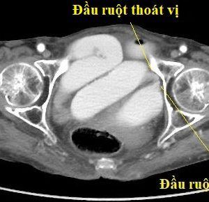 Tắc ruột