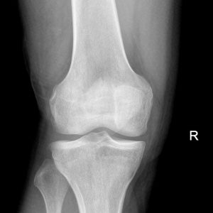 Chấn thương khớp gối