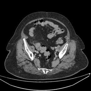 Viêm bờm mỡ đại tràng