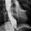 Achalasia - Ảnh 3