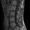 Schwannoma - Hình ảnh 3