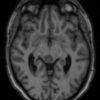 Cavernoma - Ảnh 3