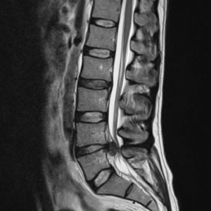 Thoát vị đĩa đệm