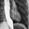 Achalasia - Ảnh 4