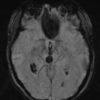 Cavernoma - Ảnh 4