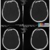 Chấn thương sọ não - Hình ảnh 4
