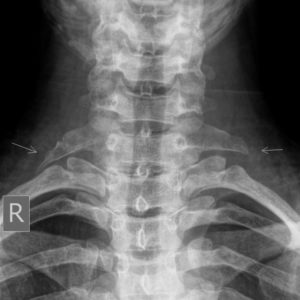 Xương sườn cổ 7