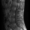 Schwannoma - Hình ảnh 5