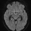 Cavernoma - Ảnh 5