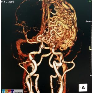 Thông động tĩnh mạch não