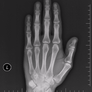 Gãy xương bàn tay