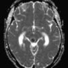 Cavernoma - Ảnh 6