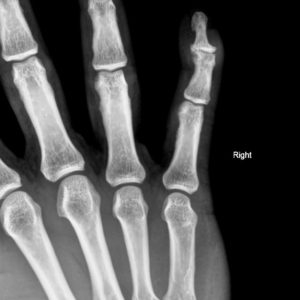 Chấn thương bàn tay