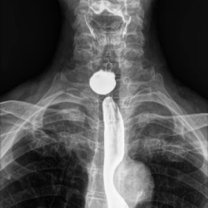 Túi thừa thực quản