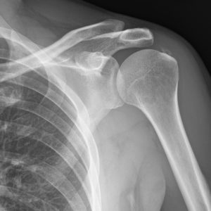 Viêm gân cơ trên gai