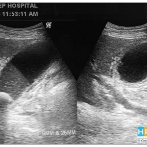 Viêm túi mật cấp