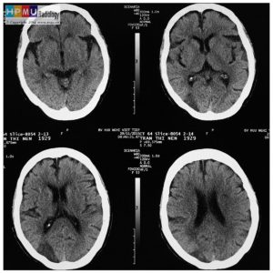 Tai biến mạch não