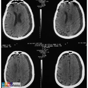 Tụ máu dưới màng cứng