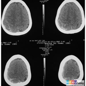 Chảy máu dưới nhện