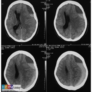 Chấn thương sọ não