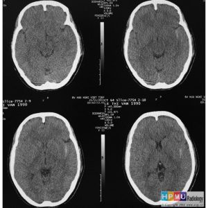 Chấn thương sọ não
