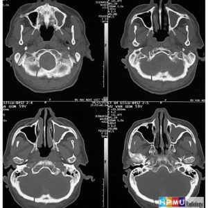 Vỡ xương hộp sọ