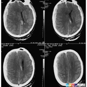 Chấn thương sọ não