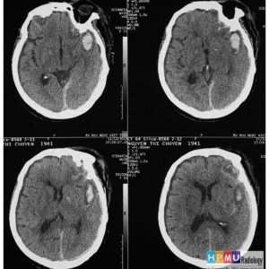 Chấn thương sọ