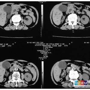 Sỏi đường mật