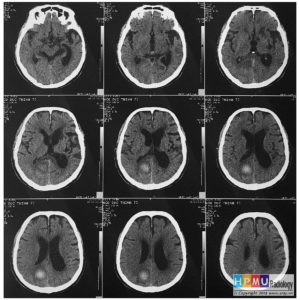 Tai biến mạch não