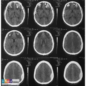 Chấn thương sọ não