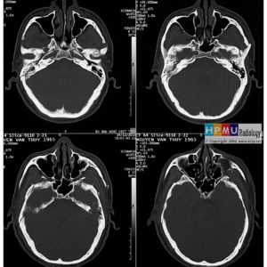 Chấn thương sọ não