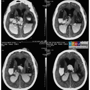 Tai biến mạch não
