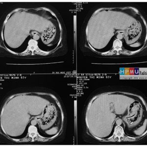 Thủng tạng rỗng