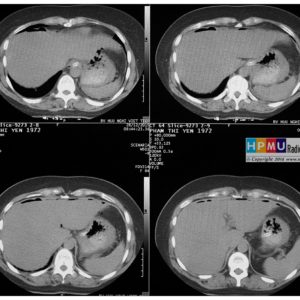 Thủng tạng rỗng