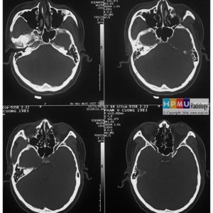 Chấn thương hàm mặt