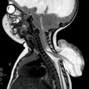 Thoát vị tủy - màng tủy
