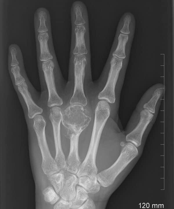 Sarcoma sụn