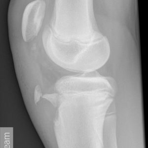 Chấn thương khớp gối