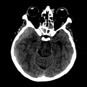 Di căn màng cứng