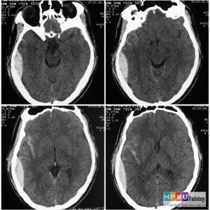 Chấn thương sọ não
