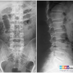 Thoái hóa cột sống