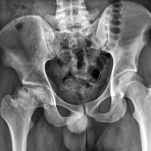 Hoại tử xương vô khuẩn